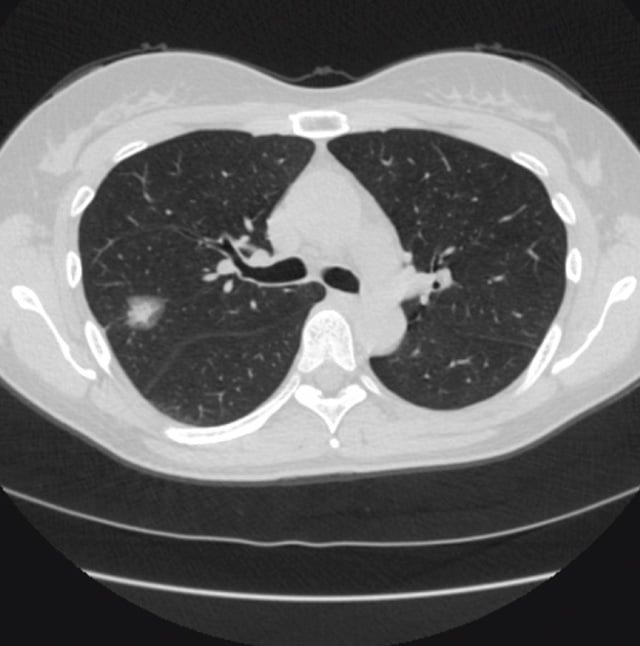 AI-lung-DetectOriginal