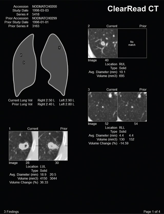 AI-lung-clearRead CT 1 AI-lung-clearRead CT 1