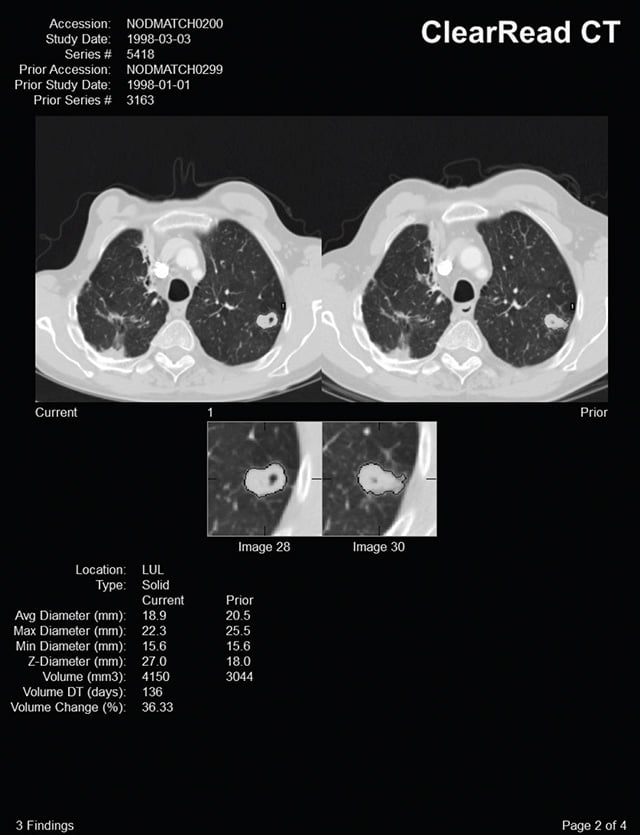 AI-lung-clearRead CT 2