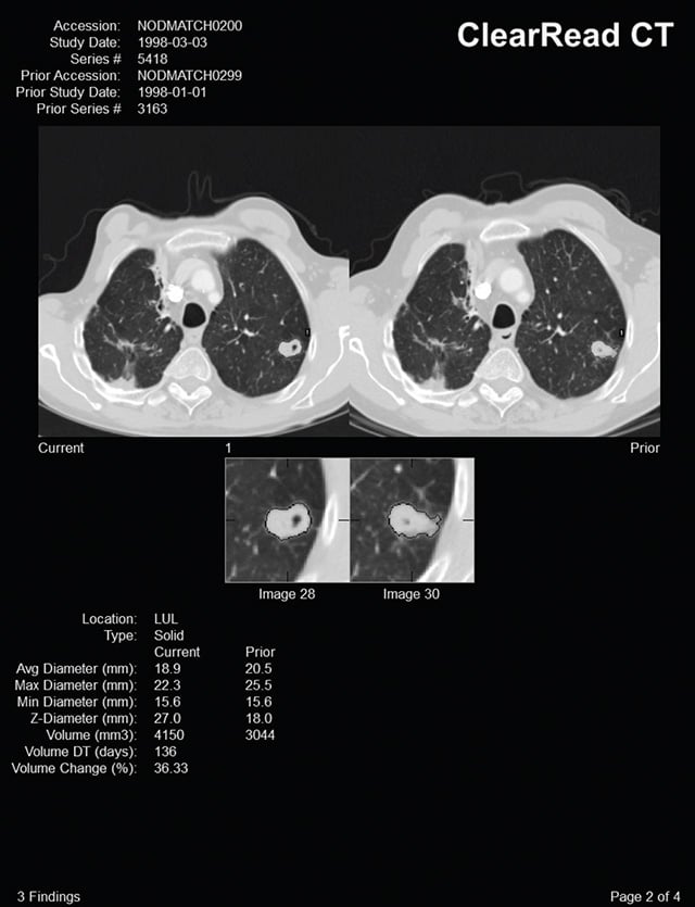 AI-lung-clearRead CT 2 AI-lung-clearRead CT 2