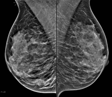 XERO breast imaging