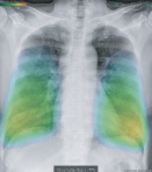 chest X-ray covid19 dedected