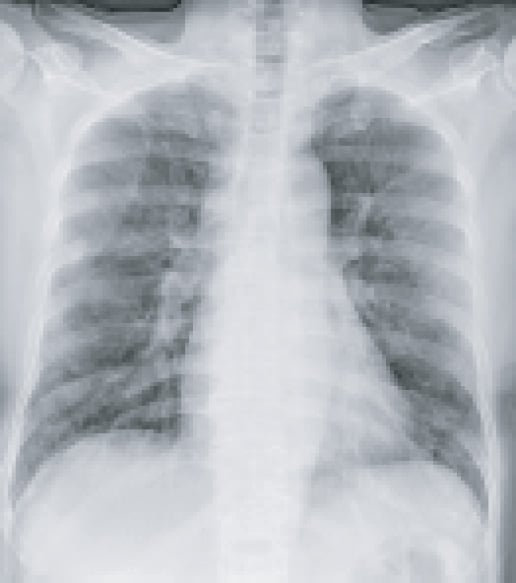 chest X-ray covid19