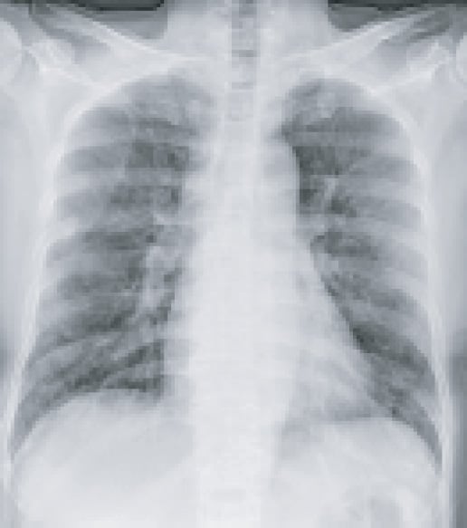 chest X-ray covid19 chest X-ray covid19
