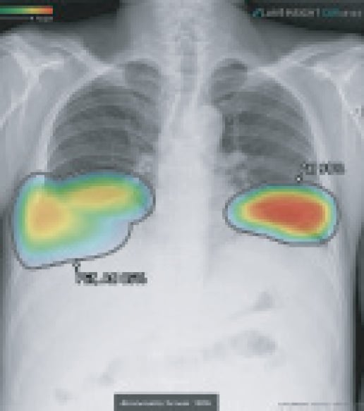 chest X-ray multiple findings dedected chest X-ray multiple findings dedected