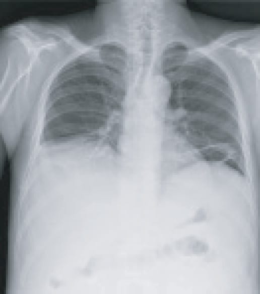 chest X-ray multiple findings