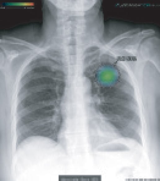 chest X-ray nodule dedected