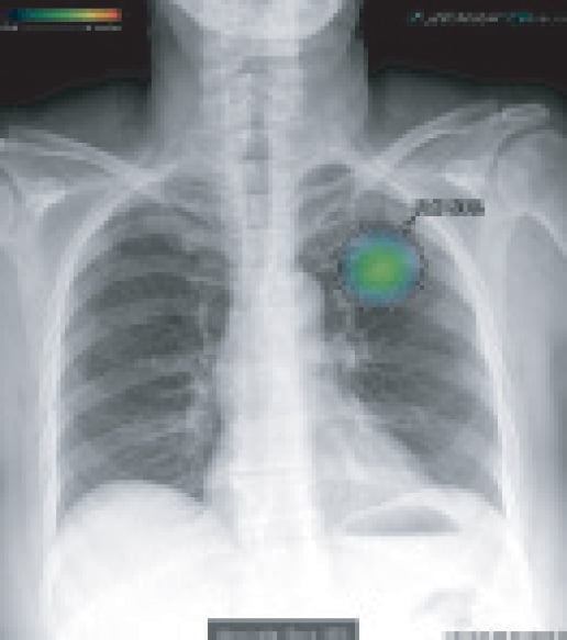 chest X-ray nodule dedected chest X-ray nodule dedected