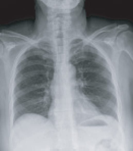 chest X-ray nodule chest X-ray - Nodule