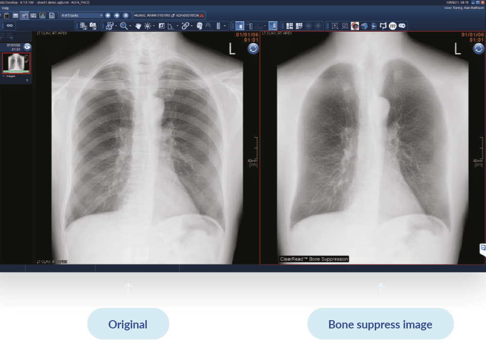 chest-x-ray-ai-visual-bonesupress