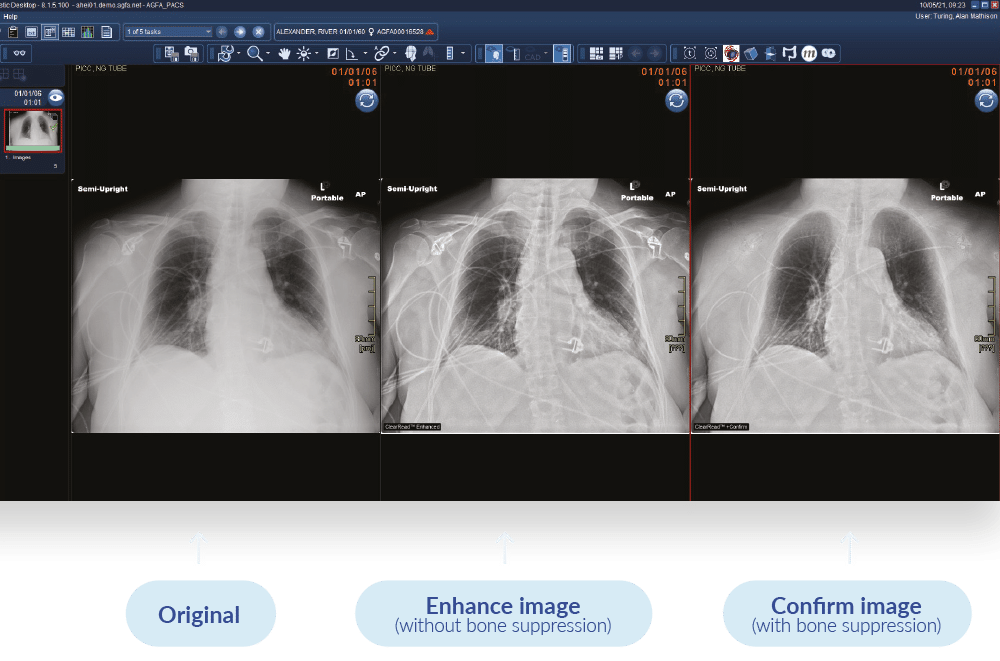 chest-x-ray-ai-visual-confirm
