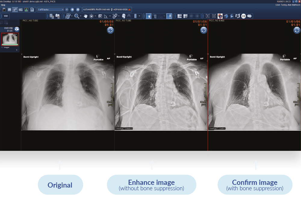 chest-x-ray-ai-visual-confirm chest-x-ray-ai-visual-confirm