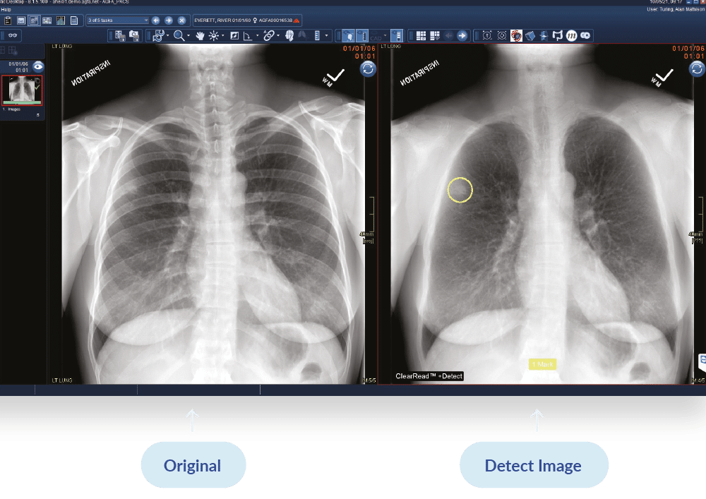 chest-x-ray-ai-visual-detect
