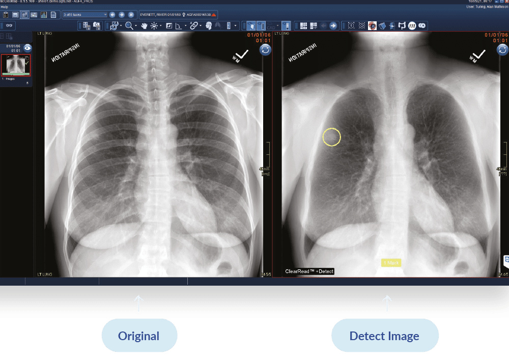 chest-x-ray-ai-visual-detect chest-x-ray-ai-visual-detect