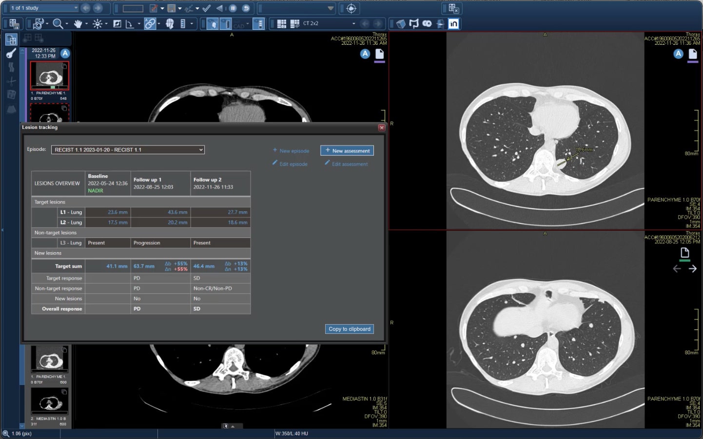 Agfa Healthcare - Lesion Tracking